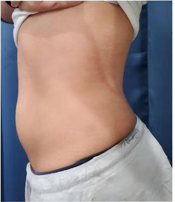 After Treatment