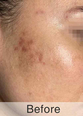 Before Treatment