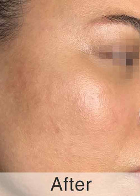 After Treatment