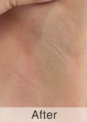 After 808N Treatment