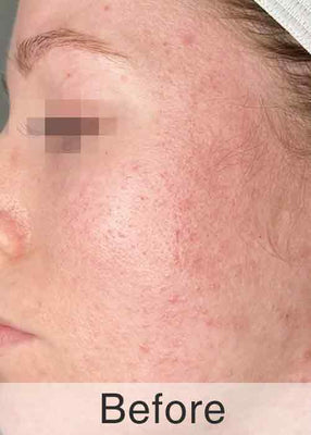 Before Treatment