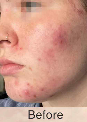 Before C6 HIFU Treatment
