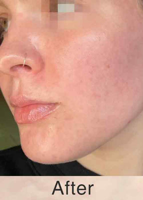 After Treatment