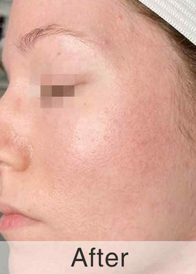 After Treatment
