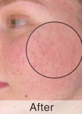 After Treatment