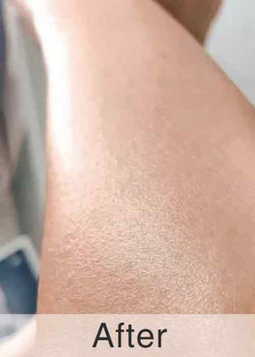 After Treatment