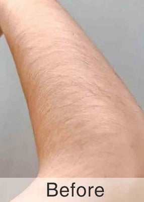 Before Treatment