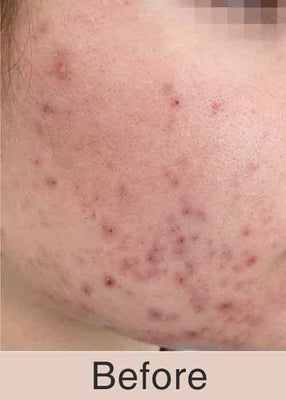 Before Treatment