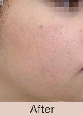 After Treatment